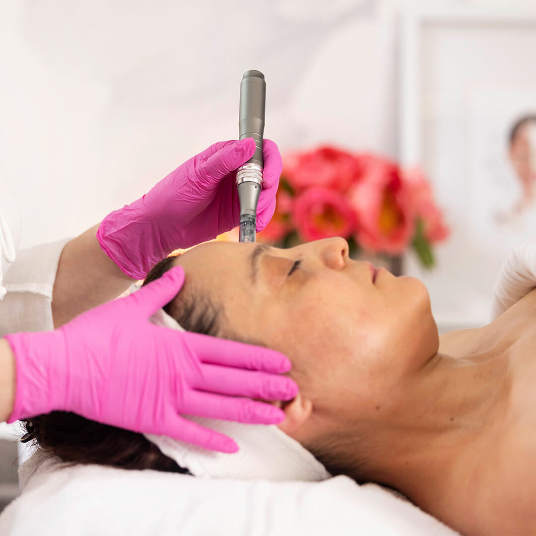 Microneedling Explained: The Treatment That Transforms Skin