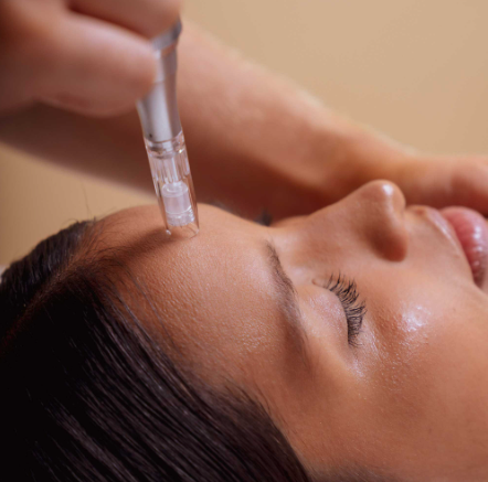 MESO Enhanced Microneedling