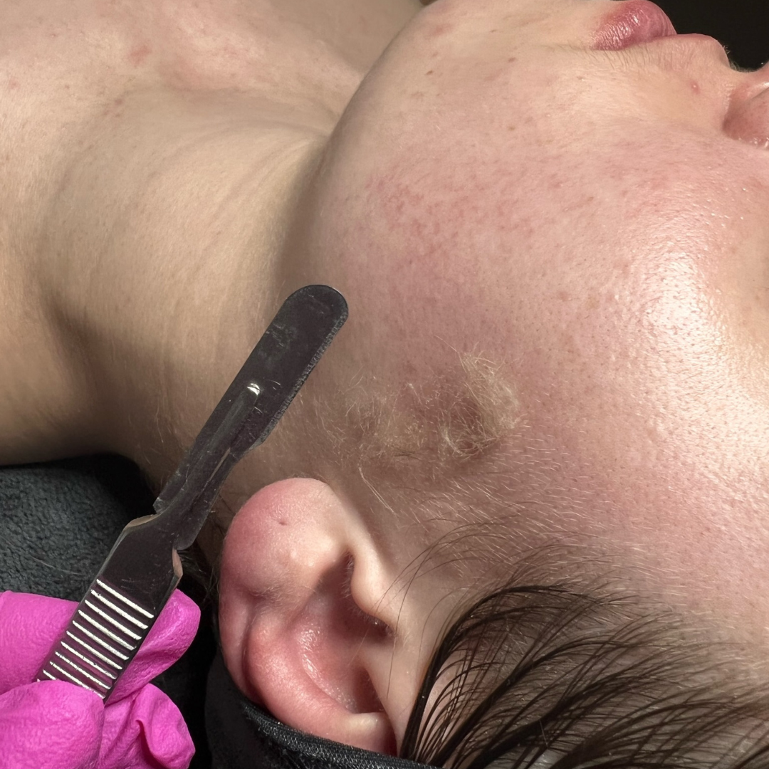 Dermaplane Standalone