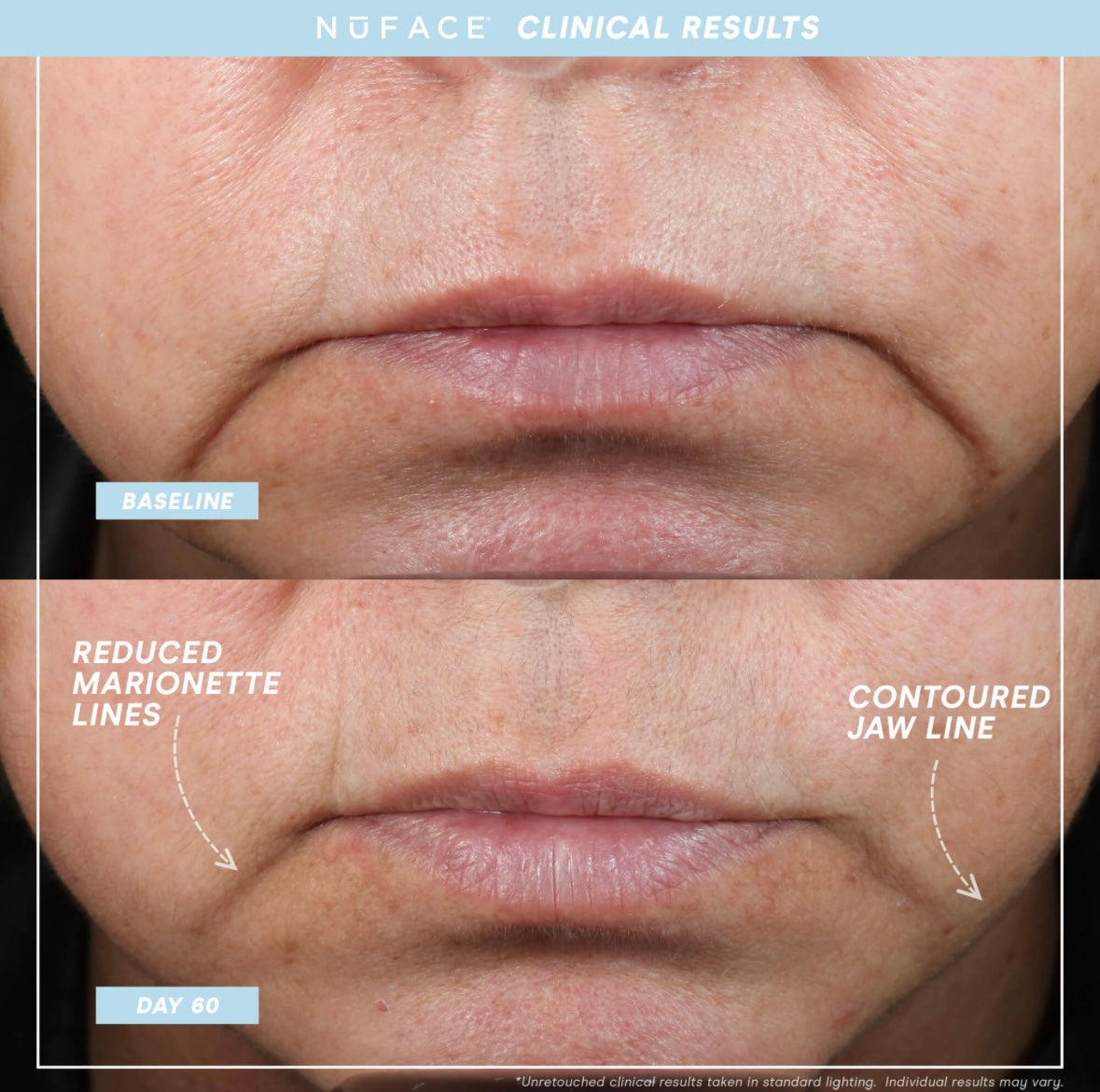 NUFACE Trinity+ Pro Smart Device Facial Toning Kit