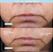 NUFACE Trinity+ Pro Smart Device Facial Toning Kit